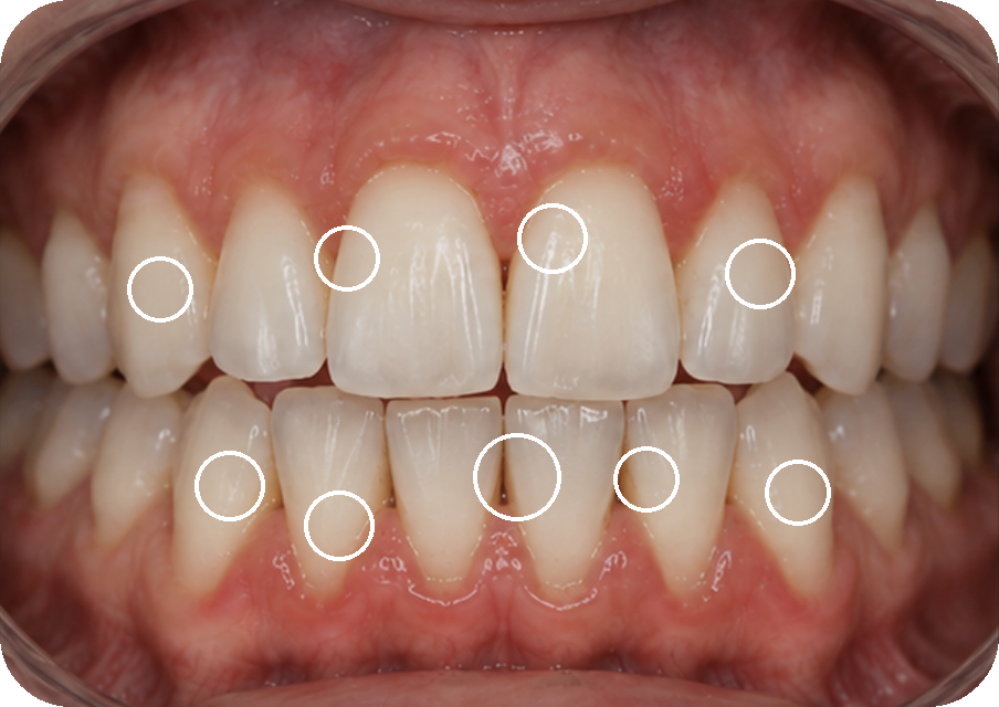Teeth shade after