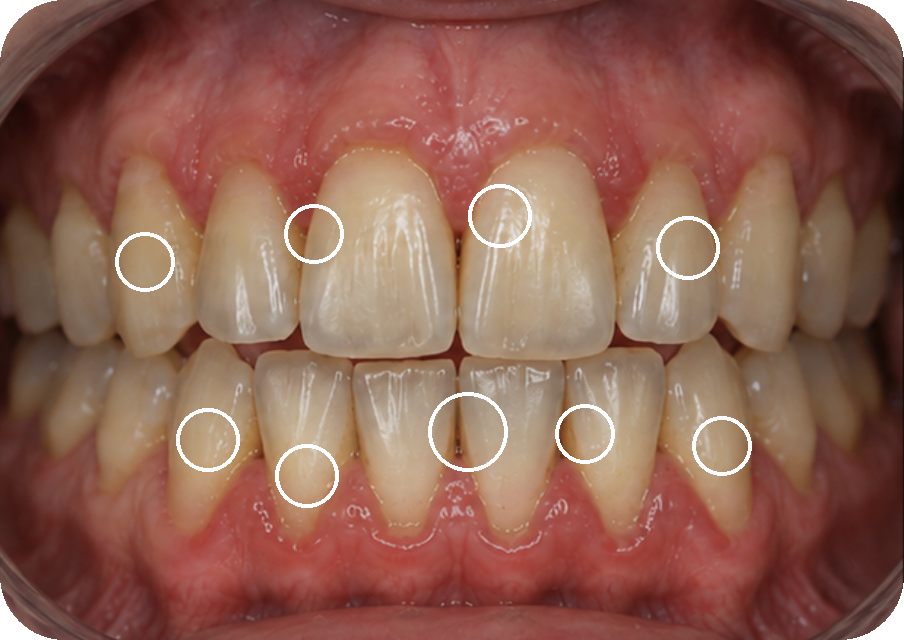 Teeth shade before